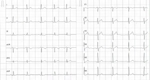 EKG