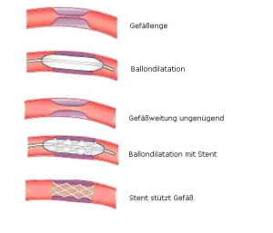 Stent